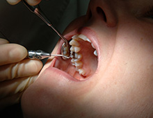 ③壊死性歯周疾患 イメージ画像